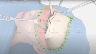 IPS® Transformation  Facial Feminization Surgery [upl. by Eisset47]