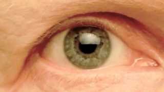 My Right Pupil Exhibiting Hippus  Pupillary Athetosis [upl. by Lewan]