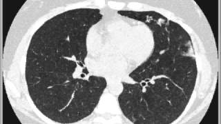 Hypersensitivity pneumonitis [upl. by La]