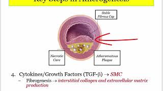 12DaysinMarch ASHD1 Atherogenesis for the USMLE Step One Exam [upl. by Narayan]