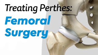 Femoral Surgery for Treating Perthes Disease in Children [upl. by Toney]