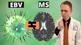 EBV Does Not Cause Multiple Sclerosis [upl. by Bradney610]