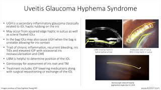 Lecture UveitisGlaucomaHyphema Syndrome 1 Slide in 5 Minutes [upl. by Brod]