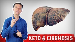 Can Keto Ketogenic Diet Help Cirrhosis of the Liver [upl. by Nuhsyar602]