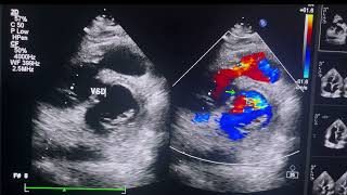 LARGE CONOVENTRICULAR VSD SHUNTING BIDIRECTIONALLYSEVERE INFUNDIBULAR OBSTRUCTIONheartcondition [upl. by Ailecra769]