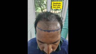 HAIR TRANSPLANTATIONShubiksha hairampskin care clinictrendingprpgfcbalaji Nagar katturtrichy19 [upl. by Resee]