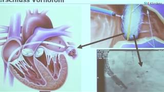 Herzrhythmusstörungen  Vorhofflimmern  Dr Wirth  SLK [upl. by Arihay]