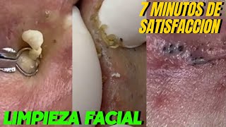 7 MINUTOS DE SATISFACCION  Extracción de Granos  Limpieza Facial [upl. by Aniral937]