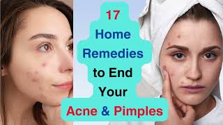 17 Home Remedies for Acne amp Pimples  Acne  Pimple  Remove ACHEPIMPLES  Viral  Trending  Video [upl. by Aralk]