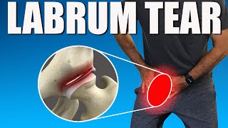 HIP LABRUM TEAR BEST Exercises Stretches amp Advice for Hip amp Groin Pain Relief [upl. by Attenwad524]