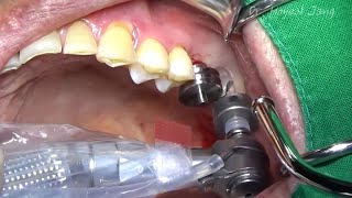 Flapless implant placement using Guide kit amp Crestal sinus lift [upl. by Naraa]