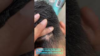 Scalp follicultis treatment  scarring  hypertrophic scar drashimagoel parisaskinclinic haircare [upl. by Baecher]