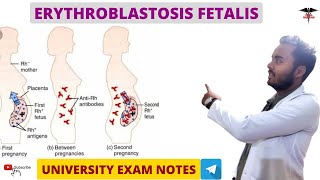 Erythroblastosis Fetalis  Blood physiology [upl. by Vipul]