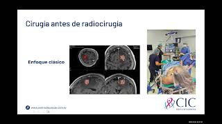 Dr Eduardo Lovo  Radiocirugía preoperatoria en Metástasis a Cerebro  CIC [upl. by Ailido809]