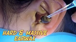 Girls Hard amp Massive Free Earwax Removal in the City [upl. by Ibbetson549]