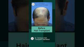 Follicular Unit Extraction FUE  Follicular Unit Transplantation FUT Hair haircare [upl. by Randal]