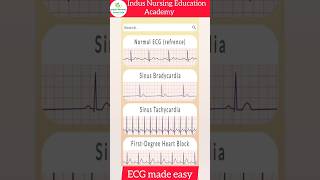 ECG Made Easy ecg mbbs neet ecginterpretation nursing youtubeshorts viral trending shorts [upl. by Robison]