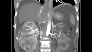 Abdomen Kidney Renal cell carcinoma invades the IVC and extends into the right atrium2 of 2 [upl. by Cowie184]