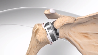 Reverse Total Shoulder Replacement with Univers Revers™ System [upl. by Gudrun]