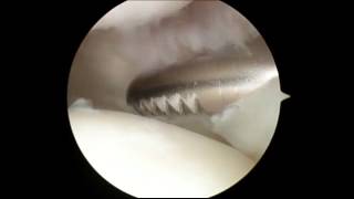 Knee  Plica Removal [upl. by Gonick]