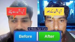 CrossedSquint Eyes Treatment  4045 Degree Squint Correction Surgery in Pakistan [upl. by Quirk]