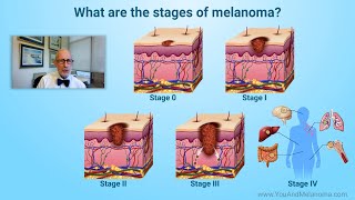 What are the stages of melanoma [upl. by Clawson]