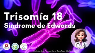 Trisomía 18 ‐ Síndrome de Edwards [upl. by Uta]