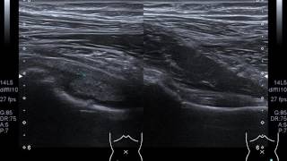 Synovitis of Right Hip Joint [upl. by Ettennaj]