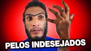 PELOS INDESEJADOS x MINOXIDIL [upl. by Kameko346]