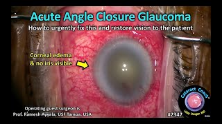 CataractCoach™ 2347 fixing acute angle closure glaucoma [upl. by Ashford]