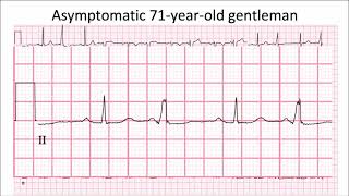 ECG in 60s  Case of quotquotVentricular Bigeminyquot [upl. by Donelu]