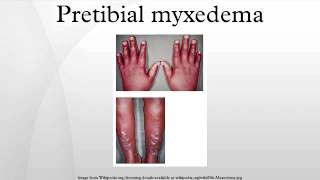 Pretibial myxedema [upl. by Osborn]