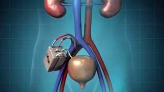 The Kidney Project at UCSF [upl. by Eissirc]