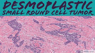 Desmoplastic Small Round Cell Tumor 5Minute Pathology Pearls [upl. by Biancha]