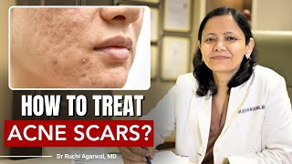 How to treat Acne Scars  Acne Scar Treatment  Acne Scars  Dr Ruchi Agarwal  Satya acnescars [upl. by Argyres]