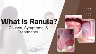 What Is Ranula 5 Detailed Causes Symptoms amp Treatments [upl. by Ute]