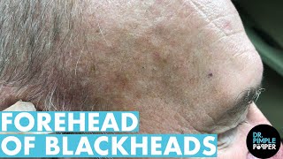 A Forehead of Blackhead Extractions Dr Pimple Popper Mines a Patients Head [upl. by Ethel]