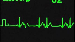 Atrial Bigeminy  ECG Simulator  Arrhythmia Simulator [upl. by Eniamrehc456]