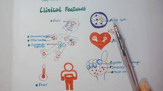 What is infective endocarditis Morphology clinical feastures Dukes criteria [upl. by Ibbie]