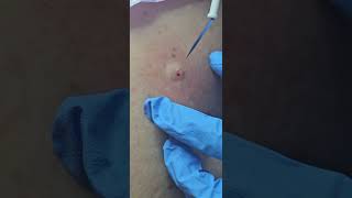 Large skin tag removal with Shave Excision  Surgery [upl. by Chapman969]