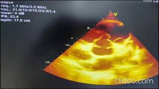 Ruptured Right Sinus of Valsalva Aneurysm RSOVA into RVOT [upl. by Benoit572]