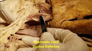 INGUINAL CANAL and Abdominal Ventral HERNIAS – Sanjoy Sanyal [upl. by Kosak55]