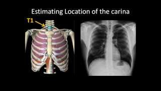 Basic Chest Radiology ET Tube Position and Complications [upl. by Draw]