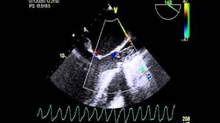 Cardiac arrest VENTRICULAR FIBRILLATION DURING TOE [upl. by Linskey]