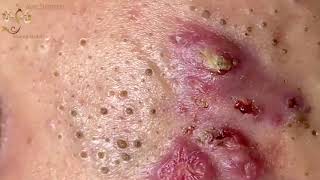 Blackheads Extraction Whiteheads Removal Pimple Popping 1 [upl. by Selway591]