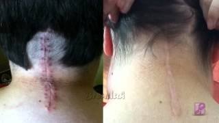 Chiari Malformation 1 Year PostOp [upl. by Lotsirhc]