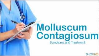 Molluscum Contagiosum ¦ Treatment and Symptoms [upl. by Cargian532]