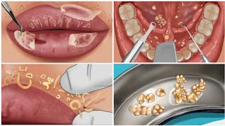 ASMR  Tonsil stone removal animation  Tonsil stone ASMR animation  Tonsil stone ASMR [upl. by Orodisi]