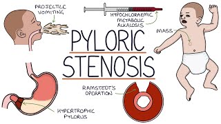 Understanding Pyloric Stenosis [upl. by Odnesor]