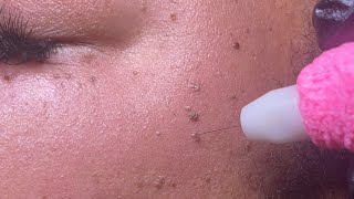 DPN Dermatosis Papulosa Nigra Removal [upl. by Ttiwed]